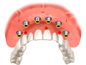 Solutions for Missing Teeth