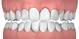 Overly Crowded Teeth - Invisalign