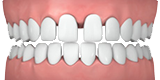 Spaced Teeth - Invisalign